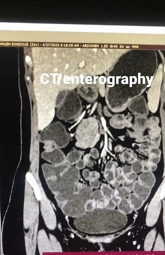 CT scan|| enterography