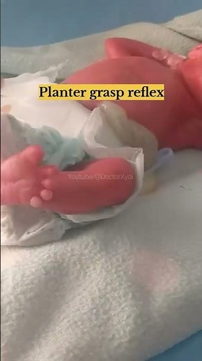 Neonatal Reflexes in a 26 Weeks Premature Baby