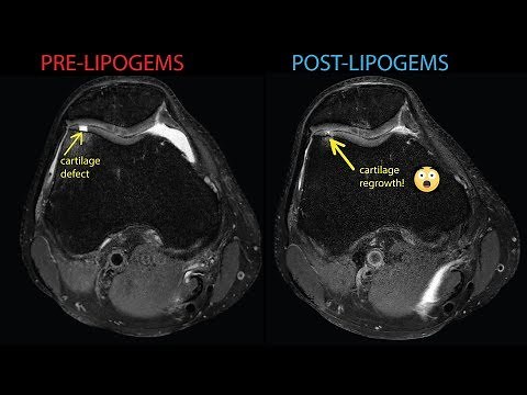 Ultrasound-guided Regenerative Medicine: cartilage regrowth | knee osteoarthritis treatment