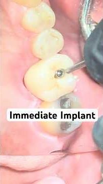 From Lost Molar to Perfect Crown — Seamless Transformation!