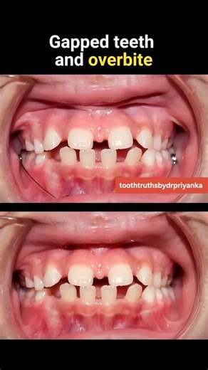 Tooth Truths by Dr. Priyanka on Instagram: "“Gapped Teeth + Overbite 😳 → Confidence Smile ✨ | Braces Magic” From gaps & overbite to a confident smile 😍 This is why orthodontics is not just about looks — it’s about function, confidence & oral health 🦷✨ 👉 Gapped teeth 👉 Deep overbite 👉 Braces treatment 👉 Gradual transformation 💡 No filters. No shortcuts. Just science & consistency. ⚠️ Still thinking braces are only for kids? Think again. 📌 Save this reel 💬 Comment “BRACES” if you want a 