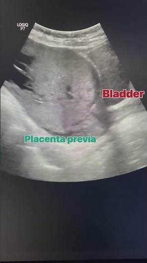 Placenta previa ultrasound #placentia #ultrasound #radiology #sonography #ultrasonography