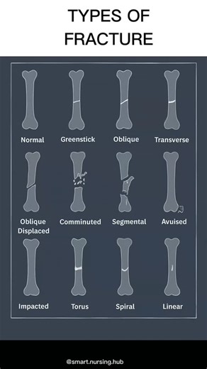 smart.nursing.hub on Instagram: "“Different types of bone fractures explained in one simple view.” “Types of fractures every medical student should know.” #viralvideo #foryou #explorepage #exploremore #viralreels #viral"