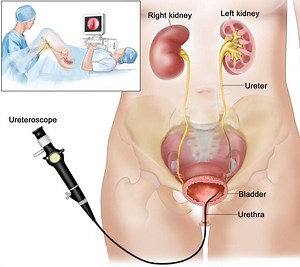 Ureteroscopy procedure, uses, risks, recovery & recovery time