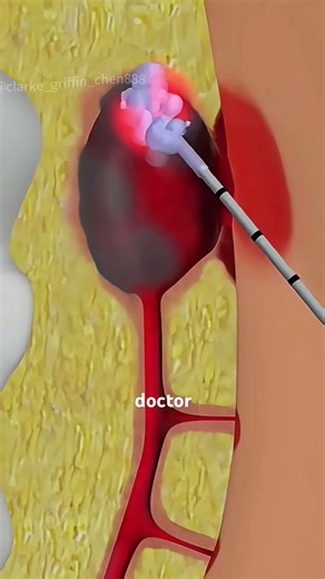How Surgeons Remove a Painful Pilonidal Sinus (3D Animation) #pilonidalsurgery