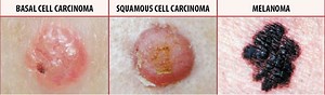 Skin Cancer - Types, Symptoms - Melanoma & Treatment