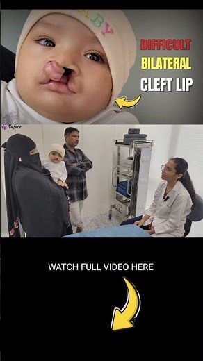 Difficult Bilateral Complete Cleft Lip and Palate | Surgery Explained