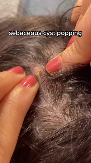 #StudentSectionSauce #headcyst #pimple #pimplepopper2021 #cyst #foryoupage