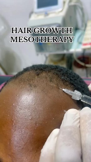Hair mesotherapy is a non-invasive medical procedure used to treat hair problems such as hair loss and thinning hair. In this method, vitamins, minerals and other nutrients are injected into the scalp with a special solution. This process helps to strengthen the hair follicles, stimulate hair growth and make the hair look thicker and healthier. Hair mesotherapy may require several sessions depending on the cause of the person's hair loss and usually has minimal side effects. For enquirer and boo