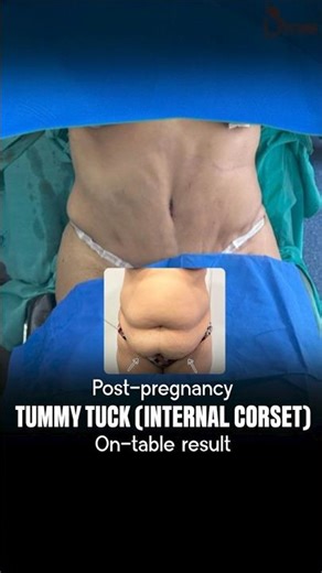 Post-Pregnancy Tummy Tuck with Internal Corset | Flat, Firm Belly Transformation