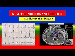 RIGHT BUNDLE BRANCH BLOCK (RBBB) Explained | Causes, Symptoms & ECG , Treatment