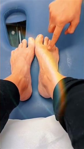 Big toe steroid injection due to OA and then mobilisation