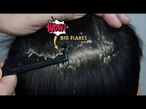 Dandruff Combing Big Flakes Satisfying #1148
