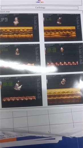 Normal Echocardiography with color doppler