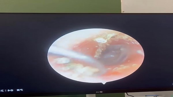 Doctors removed hundreds of grains of sand stuck in a woman's ear after she went swimming at the beach