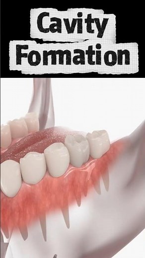 How Do Cavities (Caries) Form?
