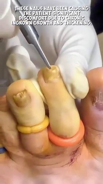 Removing TOENAILS!!😳🤯