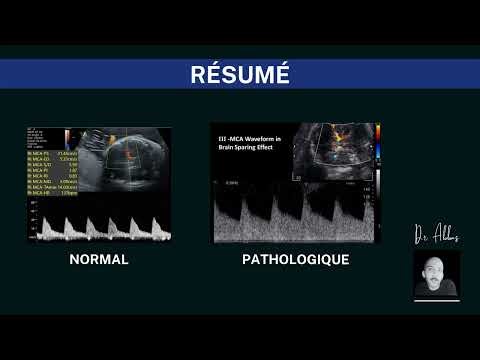 L'échographie doppler en obstétrique : épisode 06 - Doppler de l'artére cérébrale moyenne ACM