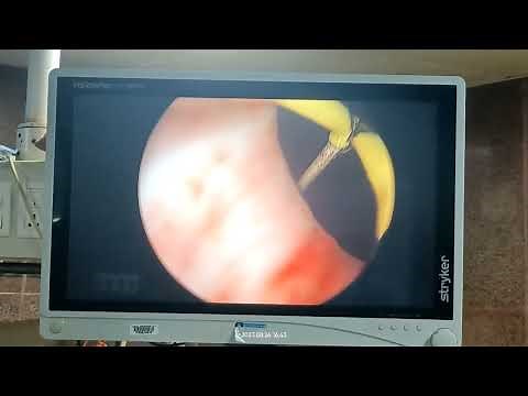 TUIP -Trans Urethral Incision of Prostate