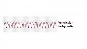 Animated electrocardiograph monitor graph that shows ventricular tachycardia abnormality