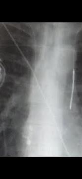 Boston Scientific info on airport security and implanted pacemakers and defibrillators