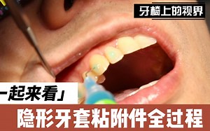 隐形牙套口腔粘附件
