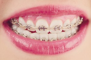 Are Power Chains The Last Step In Braces? Power Chains Simply Explained - Braces Journey