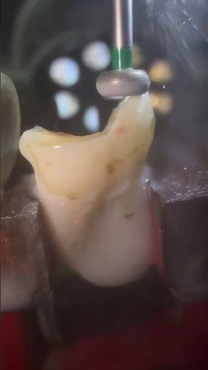 Cavities 101: How They Really Form #dentalcare #satisfying #dentalartistry #dentist