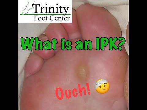 What is an Intactable Plantar Keratosis or IPK?