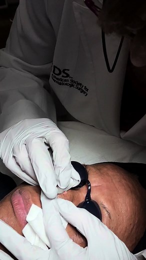 Intradermal Nevus vs. Fibrous Papules: Key Differences