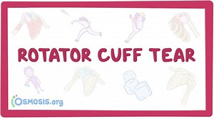 Rotator cuff tear: Video, Causes, & Meaning | Osmosis
