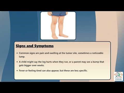 Ewing Sarcoma Explained Causes, Symptoms and Treatment, All Insights