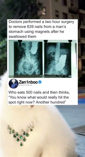 Doctors performed a two hour surgery to remove 639 nails from a man's stomach using magnets after he