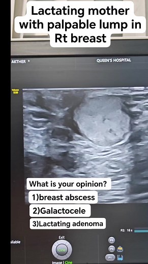 Breast Usg #sonographiccasestudy #Radiology #education #learning #ultrasound #community #reelsvideo #reelsfacebook #sonography | Sonographic case study