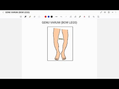 GENU VARUM | BOW LEGS