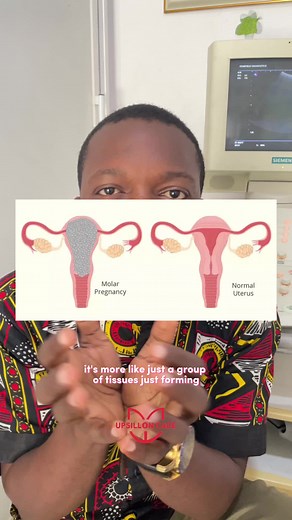 Understanding Molar Pregnancy: Signs, Symptoms, and Risks Explained