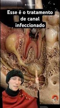 Root Canal Treatment Step-by-Step: Dealing with Infection and Pus! Explained Clearly!!