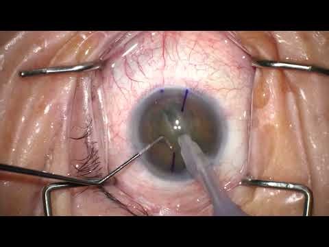 Alcon toric IOL , Cataract surgery