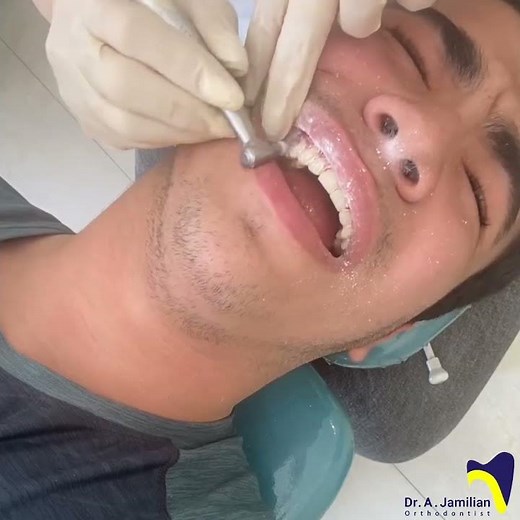 How Safe Is Braces Removal? Evaluating Enamel Protection During Orthodontic Debonding #debonding