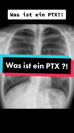 PTX = Pneumothorax! Der PTX entsteht auf unterschiedliche Art und Weisen: durch einen Unfall, durch Interventionen oder auch ganz spontan. Was alle gemein haben: es dringt Luft in den Pleuraspalt ein. Aber auch Blut könnte in den Pleuraspalt gelangen. Dies nennt man dann einen Hämatopneumothorax. So oder so, es kommt zu einen teilweisen oder kompletten Kollaps der Lunge, was in bestimmten Fällen definitiv eine Notfallsituation darstellt. Deswegen ist es gerade bei ambulanten Patienten wichtig di