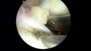 Meniscal Repair
