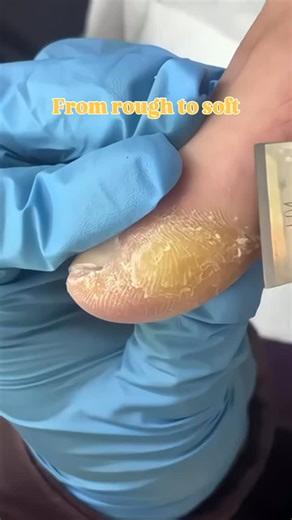 25K views · 2.7K reactions | Callus build-up like this can trap bacteria and cause cracks  Regular foot care keeps your skin healthy, soft, and pain-free  Book your foot treatment today and feel the difference instantly! ‍♀️ #footcaretips #callusremoval #pedicuretime #smoothheels #feettransformation #skincareforfeet #beautycare #feetwellness #salonservices #sanjosebeauty | Podiatrist-SJ | Facebook