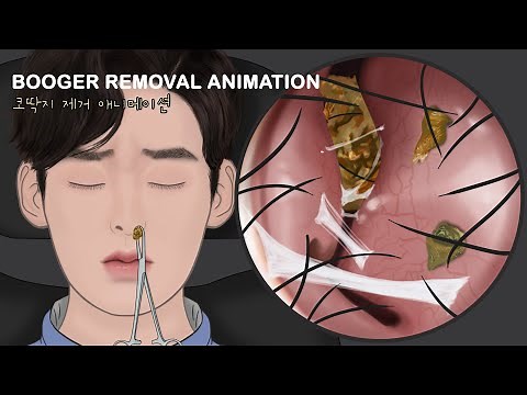 ASMR Endoscopic Nose Secretion Removal Animation / Piercing nose full of boogers!