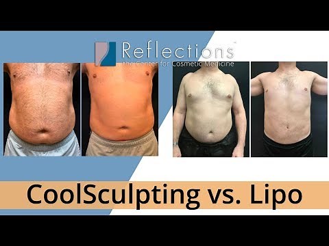 CoolSculpting vs. Lipo: Which is Better? [Price, Downtime, Pain]