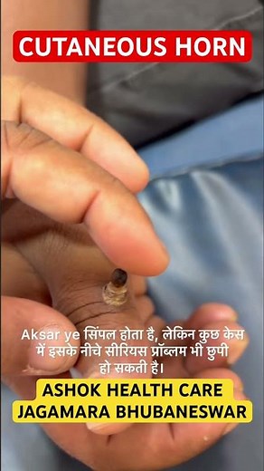 😨 Horn-like growth on your finger? Don’t ignore it! ⚠️#shorts #ashokhealthcare #hpv #wart #thuja