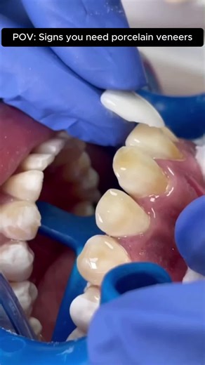 Signs You Might Need Porcelain Veneers for a Smile Makeover