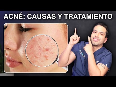 Acné: Causas y Tratamiento