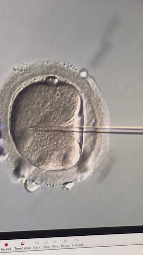 Understanding Intracytoplasmic Sperm Injection (ICSI) in IVF