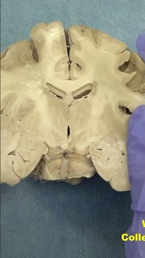 Mammillary level of hypothalamus #neuroanatomy #brain #hypothalamus#humanbrain