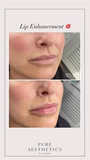 Gemma Parker | Aesthetics | Lip Filler | Anti-aging | Hartlepool | A little lip filler 💋 and this lady is all smiles again 😁 Teosyal RHA Kiss 0.7ml Such a beautiful lip enhancement ❤️ if you agree ⏱... | Instagram